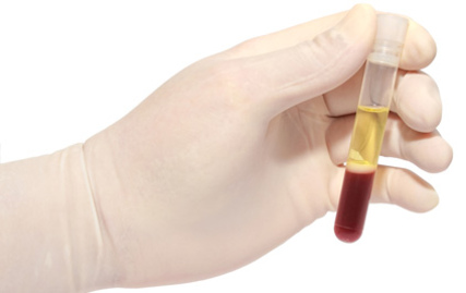 плазмолифтинг суставов отзывы